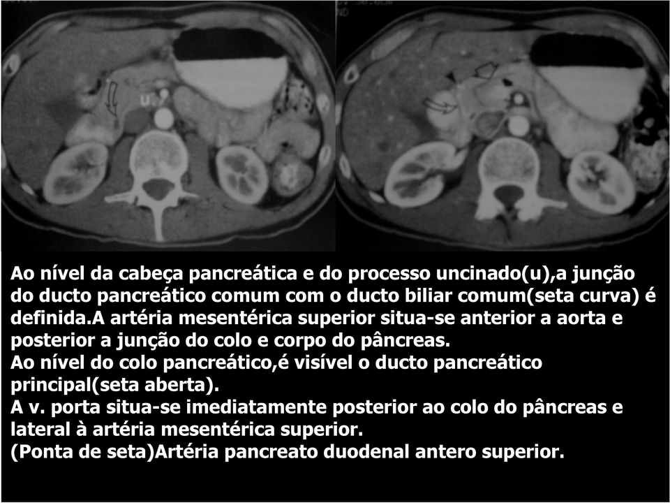 Ao nível do colo pancreático,é visível o ducto pancreático principal(seta aberta). A v.