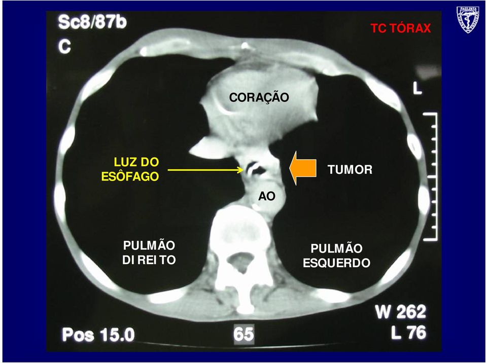 TUMOR PULMÃO