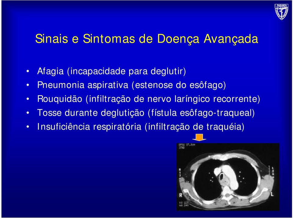 (infiltração de nervo laríngico recorrente) Tosse durante deglutição