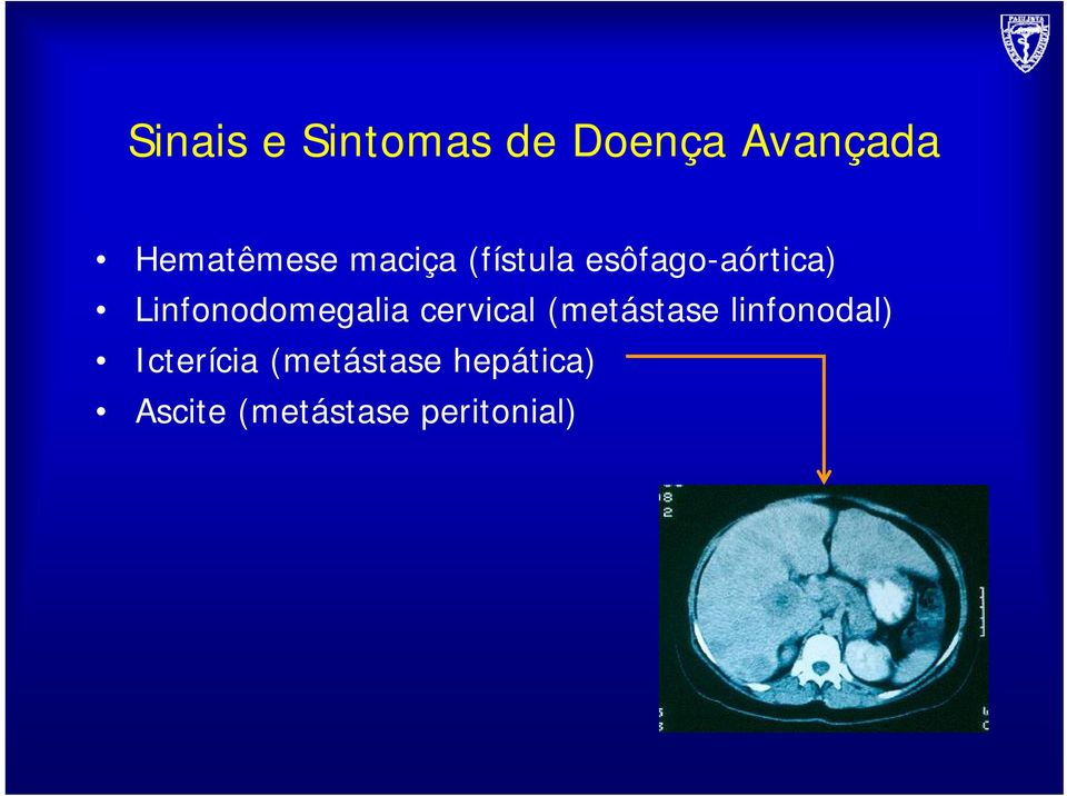 Linfonodomegalia cervical (metástase