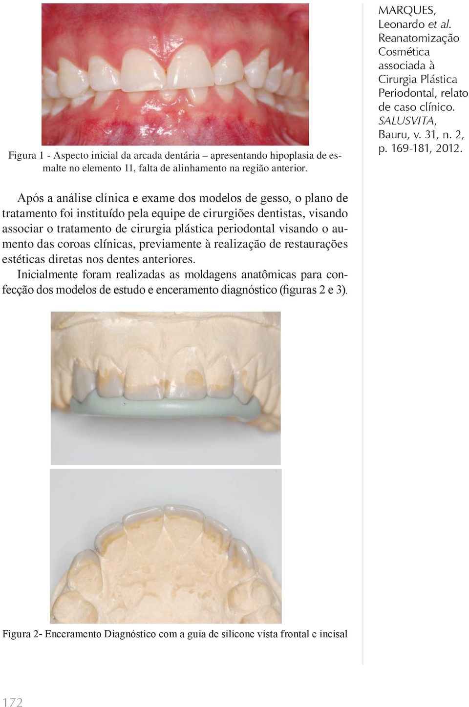 plástica periodontal visando o aumento das coroas clínicas, previamente à realização de restaurações estéticas diretas nos dentes anteriores.