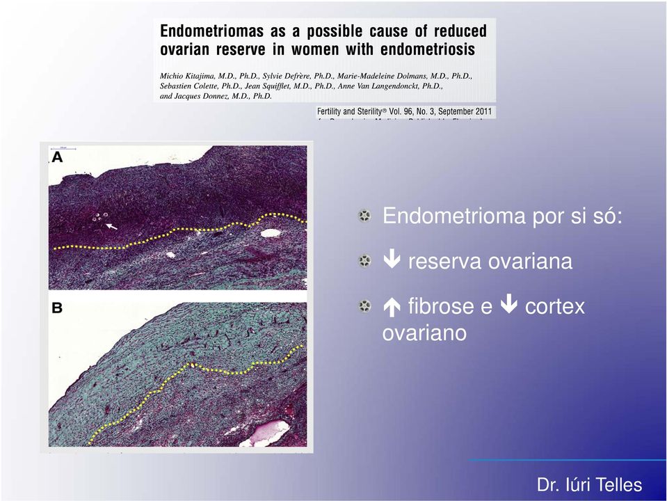 ovariana fibrose