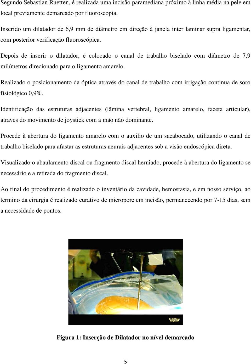 Depois de inserir o dilatador, é colocado o canal de trabalho biselado com diâmetro de 7,9 milímetros direcionado para o ligamento amarelo.