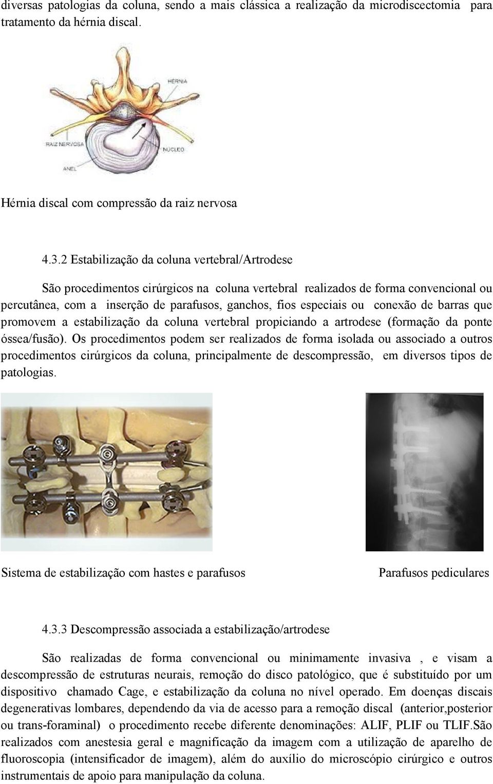 conexão de barras que promovem a estabilização da coluna vertebral propiciando a artrodese (formação da ponte óssea/fusão).