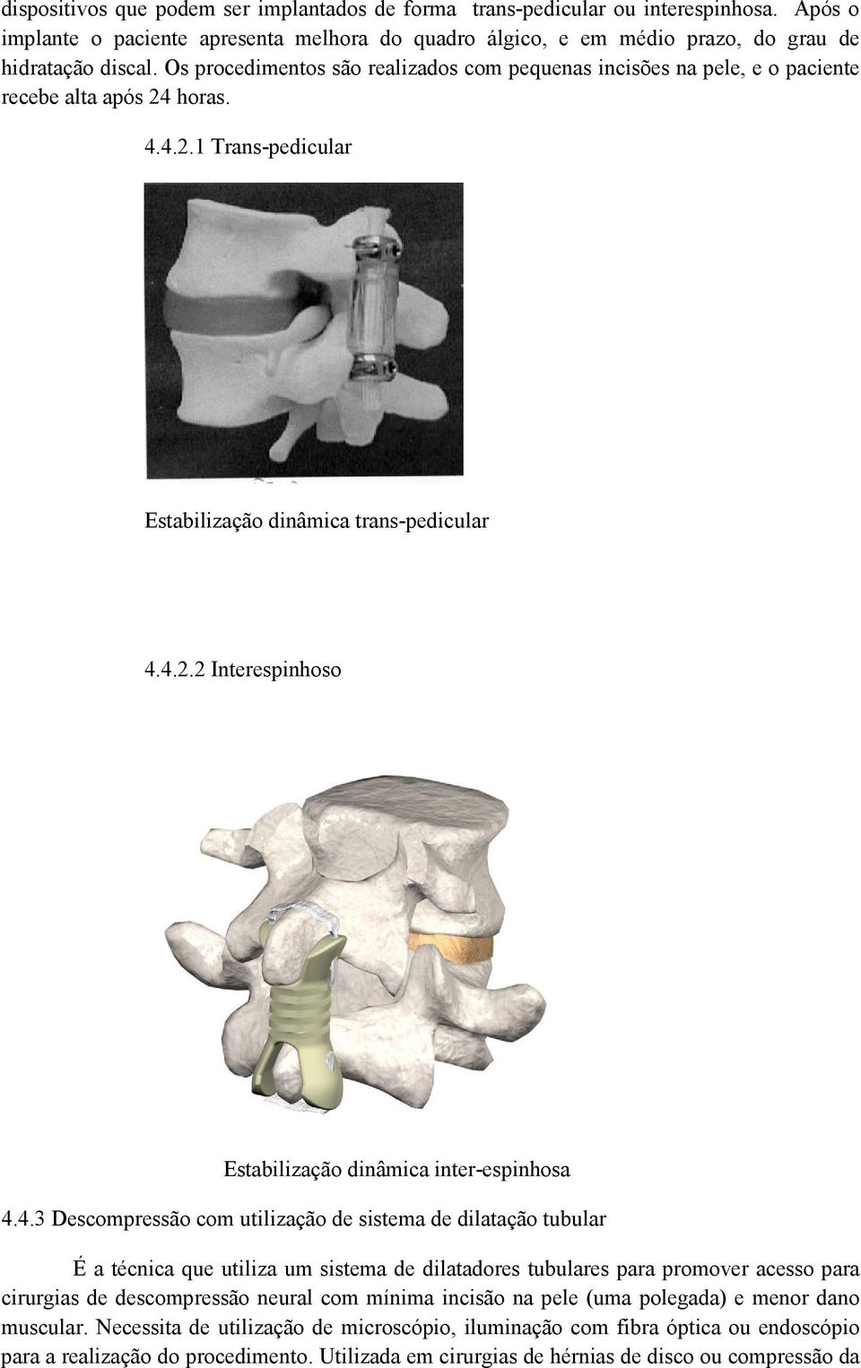 4.3 Descompressão com utilização de sistema de dilatação tubular É a técnica que utiliza um sistema de dilatadores tubulares para promover acesso para cirurgias de descompressão neural com mínima