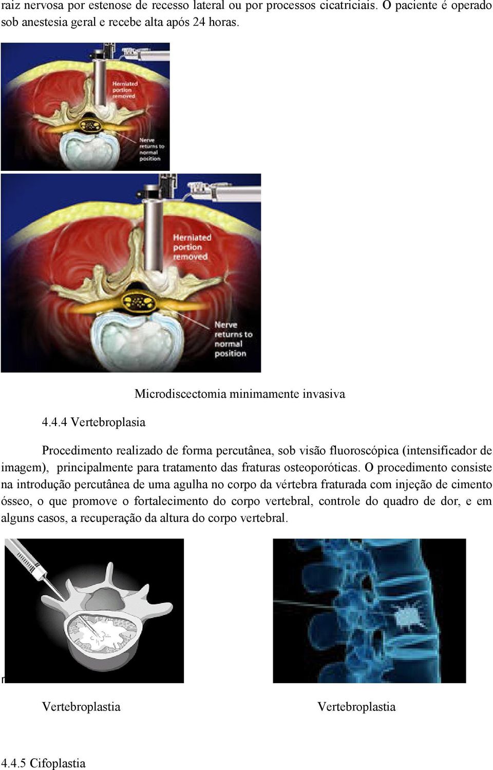 4.4 Vertebroplasia Microdiscectomia minimamente invasiva Procedimento realizado de forma percutânea, sob visão fluoroscópica (intensificador de imagem), principalmente