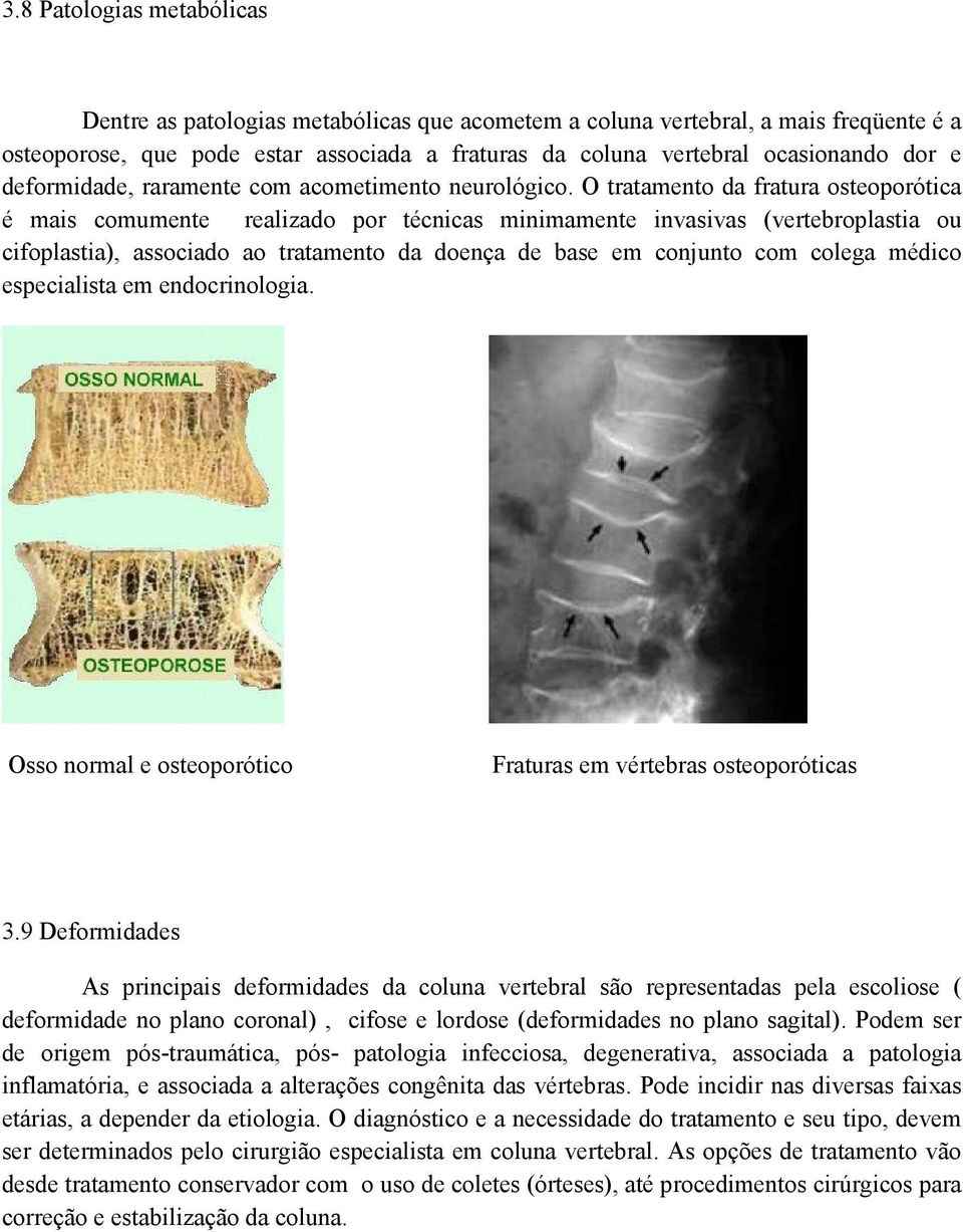 O tratamento da fratura osteoporótica é mais comumente realizado por técnicas minimamente invasivas (vertebroplastia ou cifoplastia), associado ao tratamento da doença de base em conjunto com colega