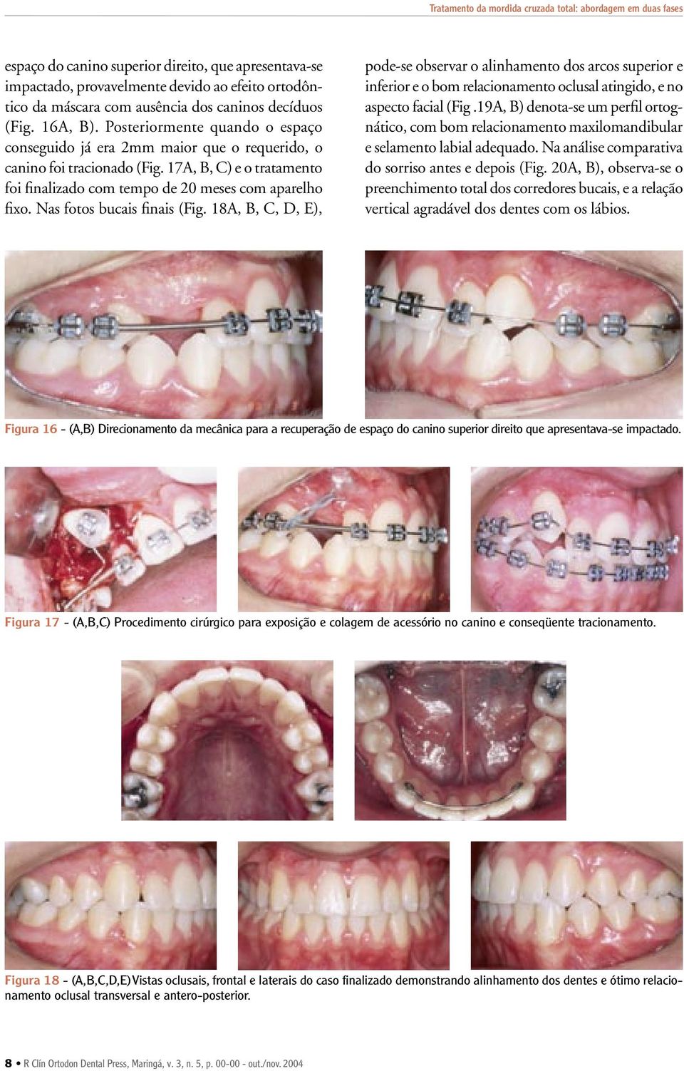 17A, B, C) e o tratamento foi finalizado com tempo de 20 meses com aparelho fixo. Nas fotos bucais finais (Fig.