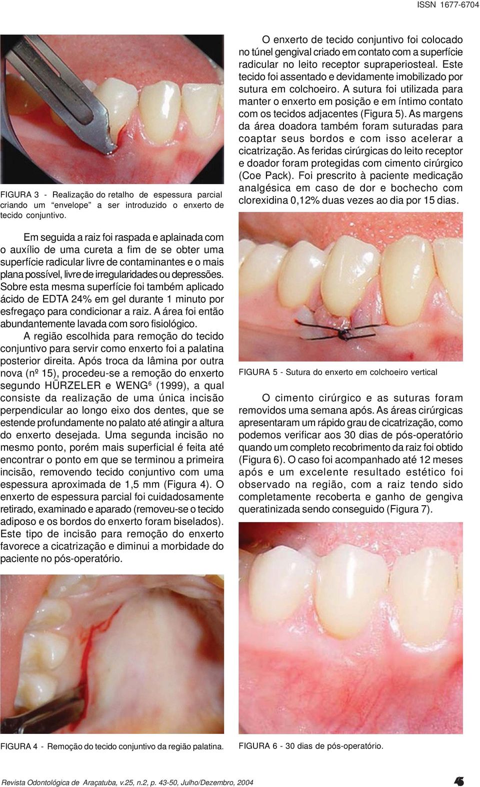 Sobre esta mesma superfície foi também aplicado ácido de EDTA 24% em gel durante 1 minuto por esfregaço para condicionar a raiz. A área foi então abundantemente lavada com soro fisiológico.