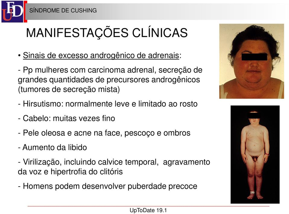 rosto - Cabelo: muitas vezes fino - Pele oleosa e acne na face, pescoço e ombros - Aumento da libido - Virilização,