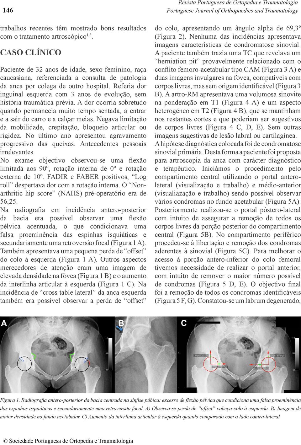 Referia dor inguinal esquerda com 3 anos de evolução, sem história traumática prévia. A dor ocorria sobretudo quando permanecia muito tempo sentada, a entrar e a sair do carro e a calçar meias.