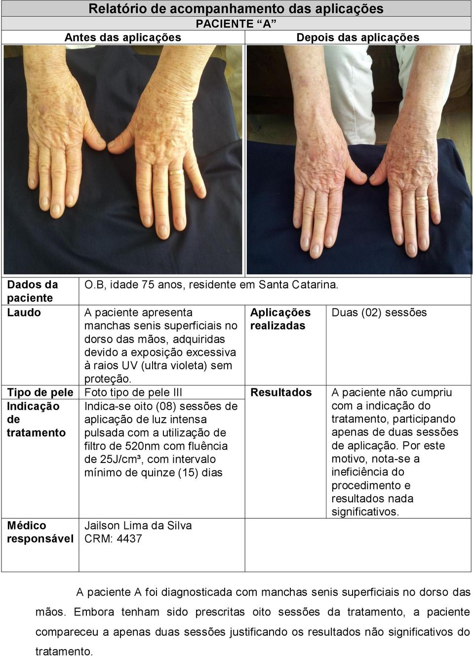 Aplicações realizadas Duas (02) sessões Tipo de pele Foto tipo de pele III Resultados A paciente não cumpriu Indicação de tratamento Indica-se oito (08) sessões de aplicação de luz intensa pulsada