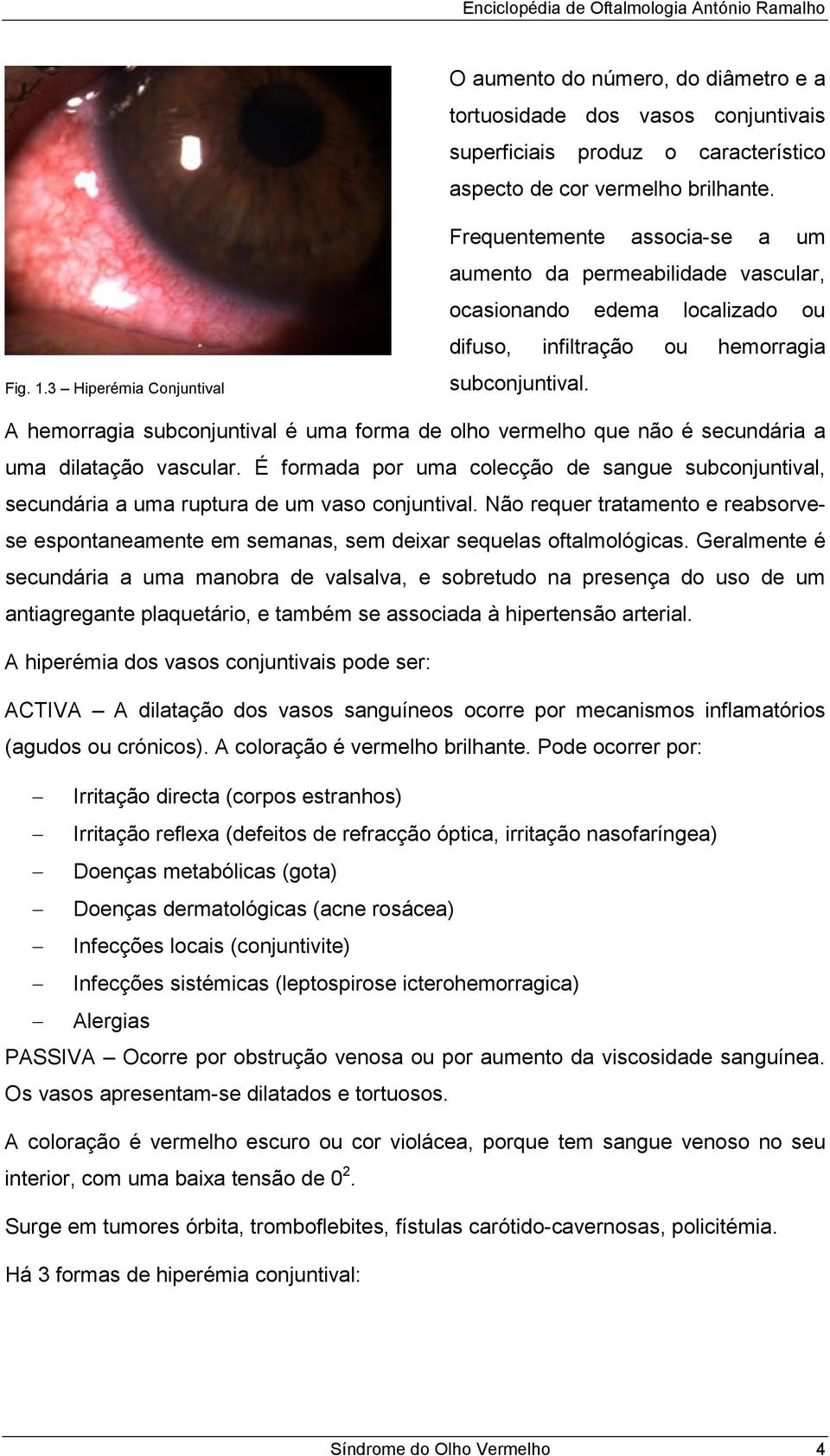 A hemorragia subconjuntival é uma forma de olho vermelho que não é secundária a uma dilatação vascular.