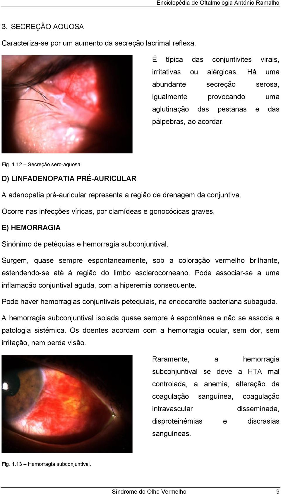 D) LINFADENOPATIA PRÉ-AURICULAR A adenopatia pré-auricular representa a região de drenagem da conjuntiva. Ocorre nas infecções víricas, por clamídeas e gonocócicas graves.