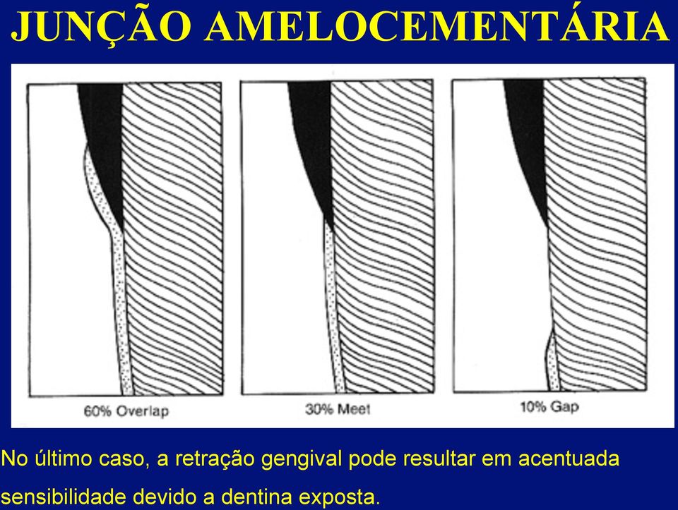 gengival pode resultar em