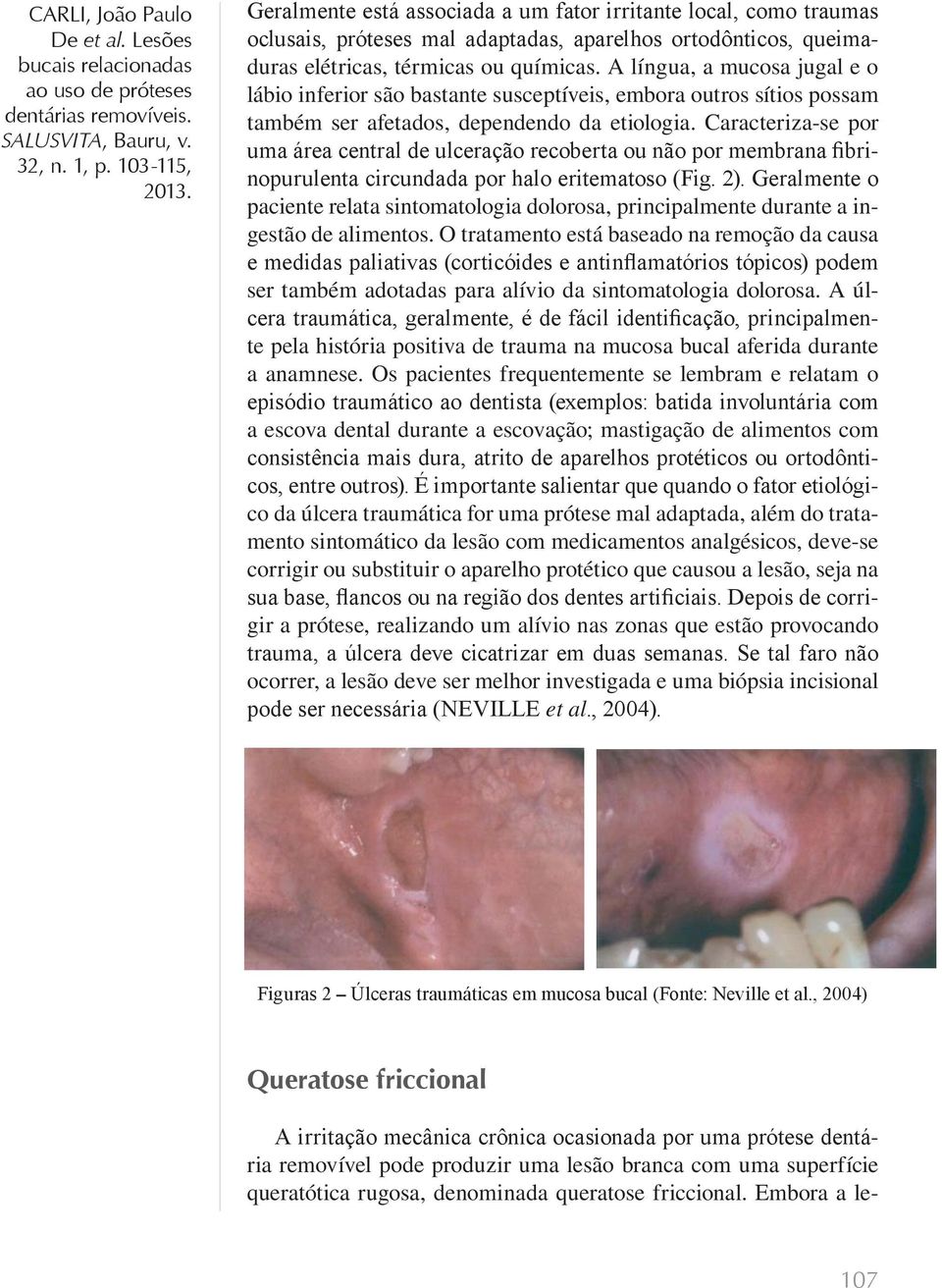 Caracteriza-se por uma área central de ulceração recoberta ou não por membrana fibrinopurulenta circundada por halo eritematoso (Fig. 2).