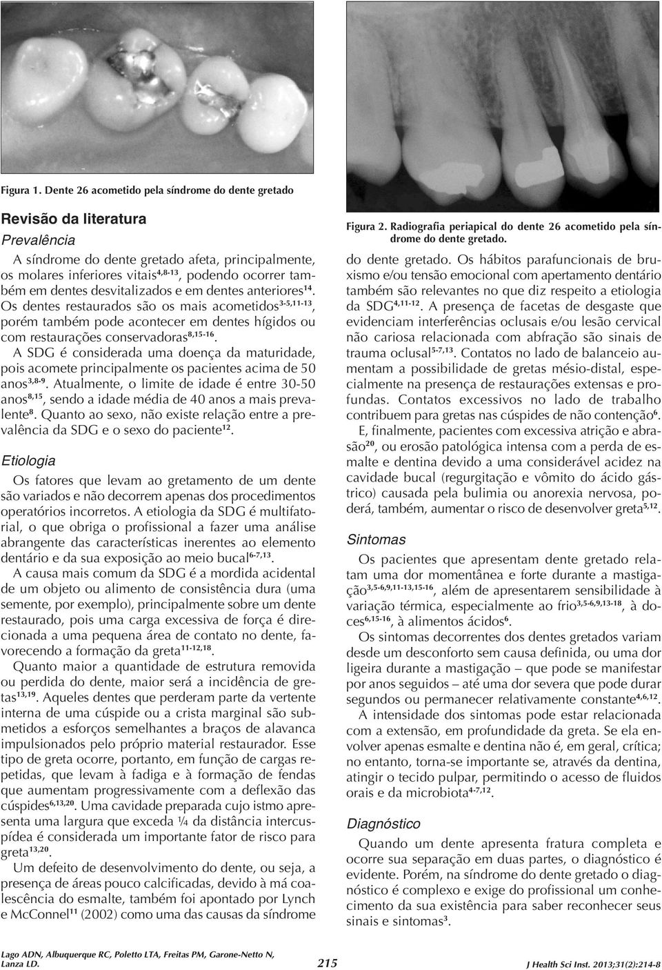 dentes desvitalizados e em dentes anteriores 14. Os dentes restaurados são os mais acometidos 3-5,11-13, porém também pode acontecer em dentes hígidos ou com restaurações conservadoras 8,15-16.