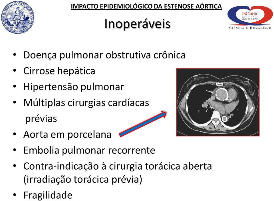 Aorta em porcelana Embolia pulmonar recorrente Contra-indicação