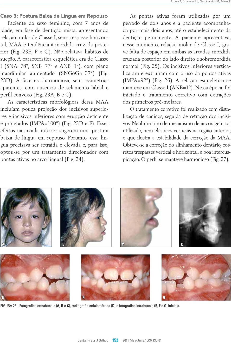 característica esquelética era de lasse I (SN=78º, SN=77º e N=1º), com plano mandibular aumentado (SNGoGn=37º) (Fig. 23).