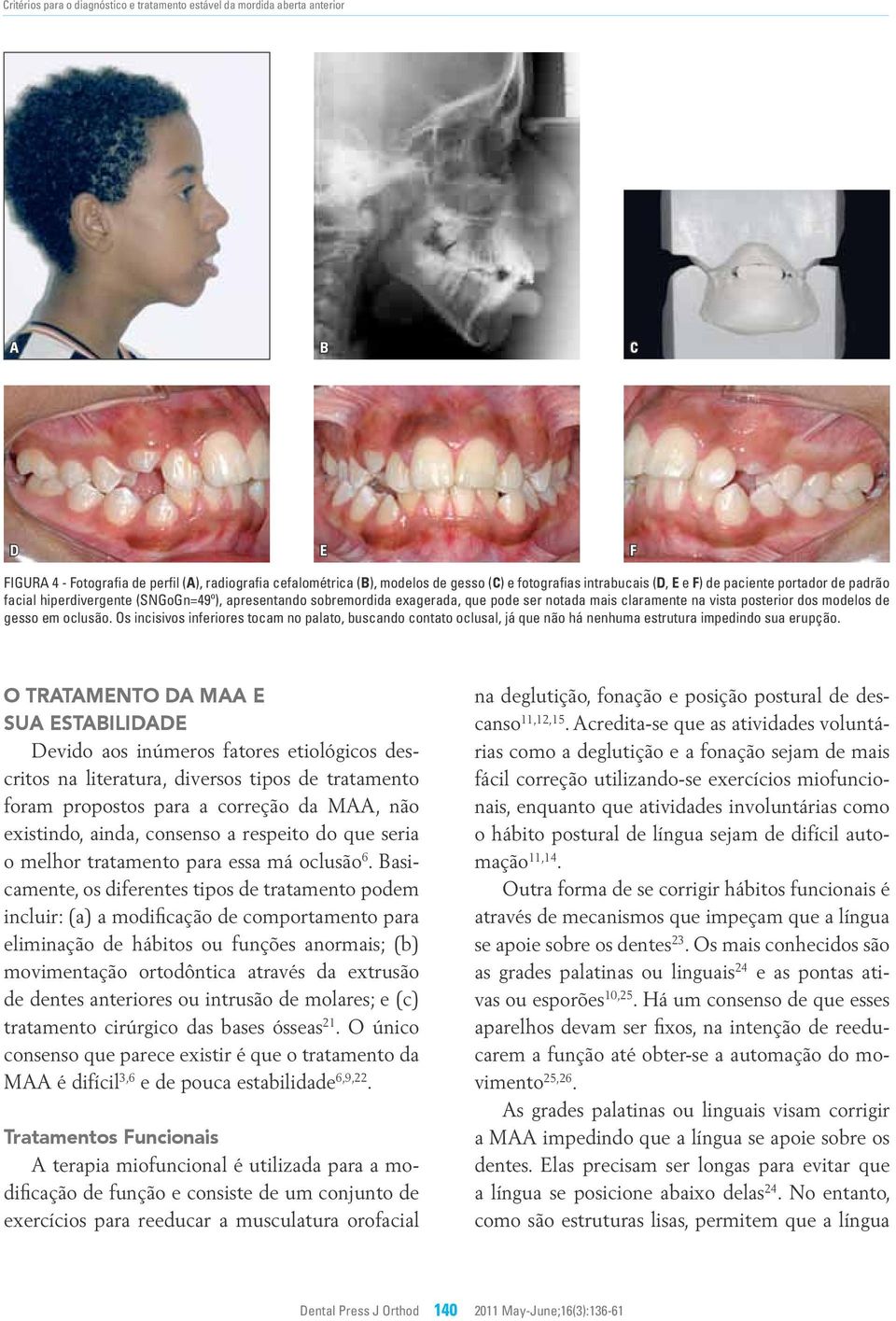 Os incisivos inferiores tocam no palato, buscando contato oclusal, já que não há nenhuma estrutura impedindo sua erupção.