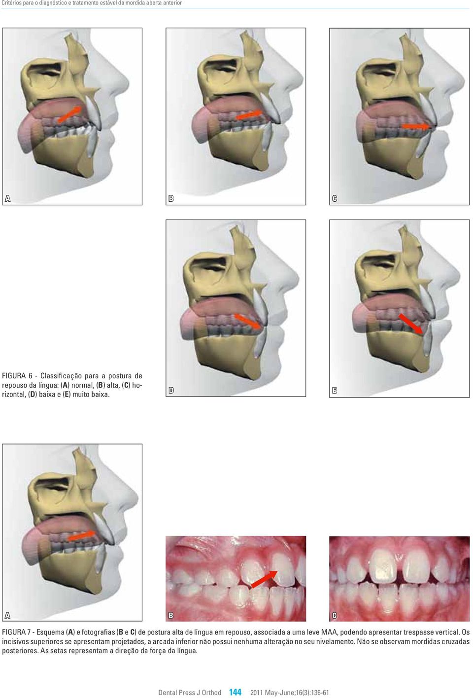 E Figur 7 - Esquema () e fotografias ( e ) de postura alta de língua em repouso, associada a uma leve M, podendo apresentar trespasse vertical.