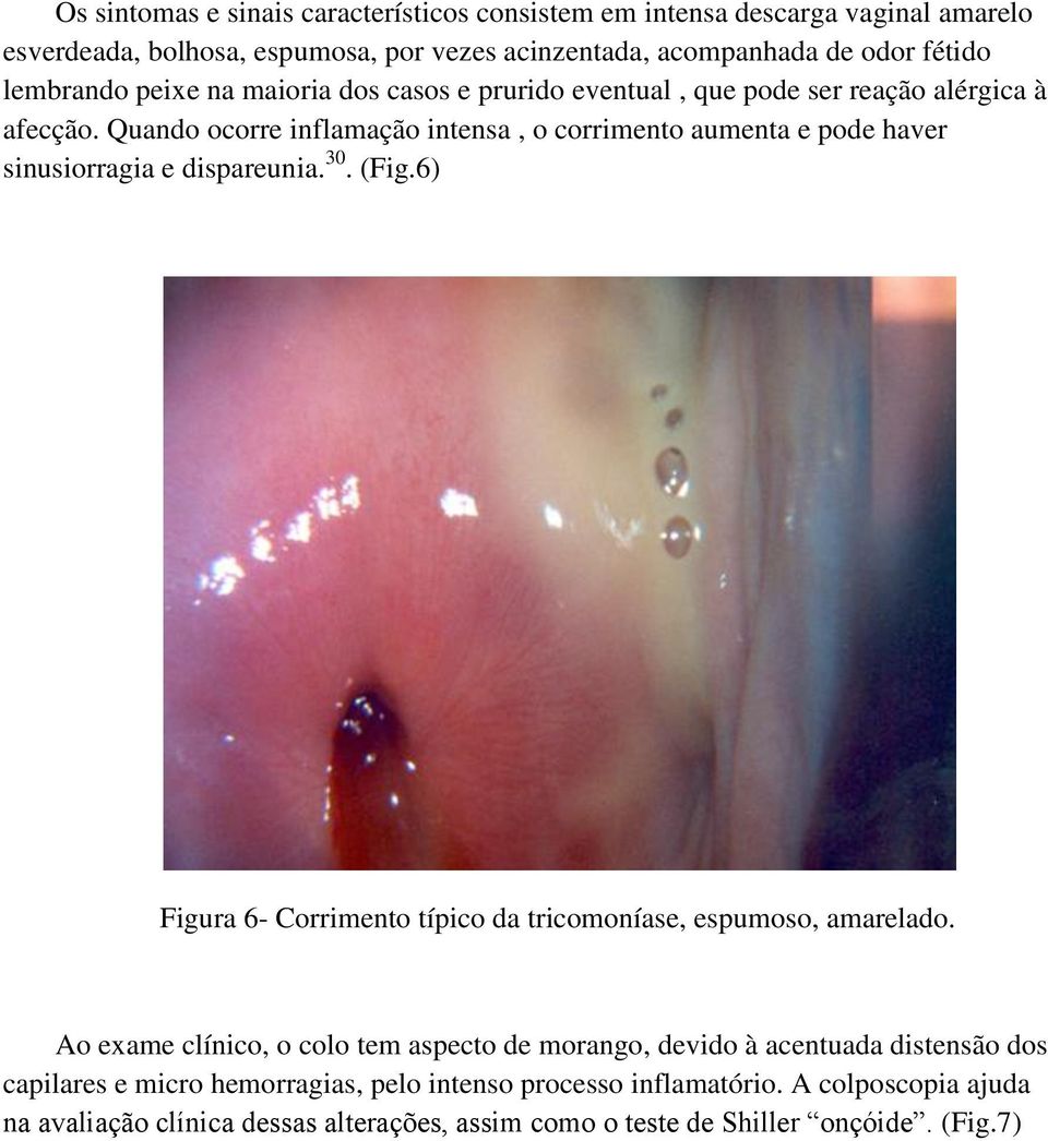 Quando ocorre inflamação intensa, o corrimento aumenta e pode haver sinusiorragia e dispareunia. 30. (Fig.