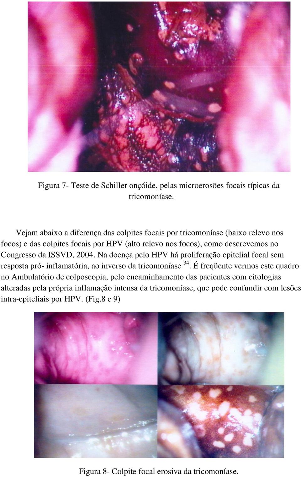 Congresso da ISSVD, 2004. Na doença pelo HPV há proliferação epitelial focal sem resposta pró- inflamatória, ao inverso da tricomoníase 34.