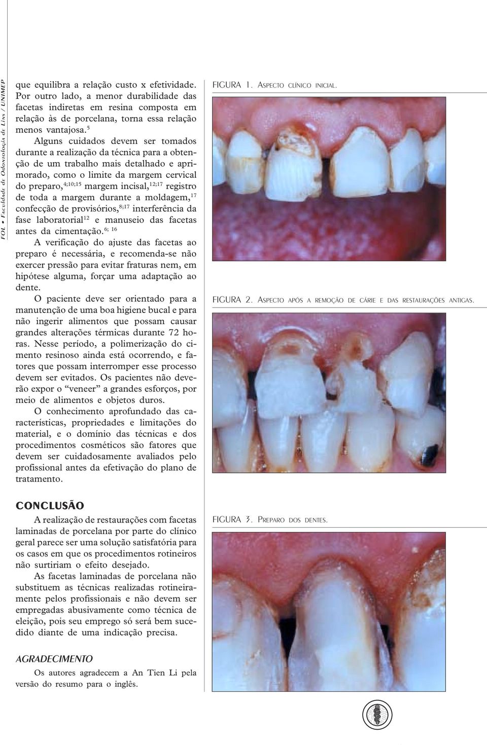 5 Alguns cuidados devem ser tomados durante a realização da técnica para a obtenção de um trabalho mais detalhado e aprimorado, como o limite da margem cervical do preparo, 4;10;15 margem incisal,