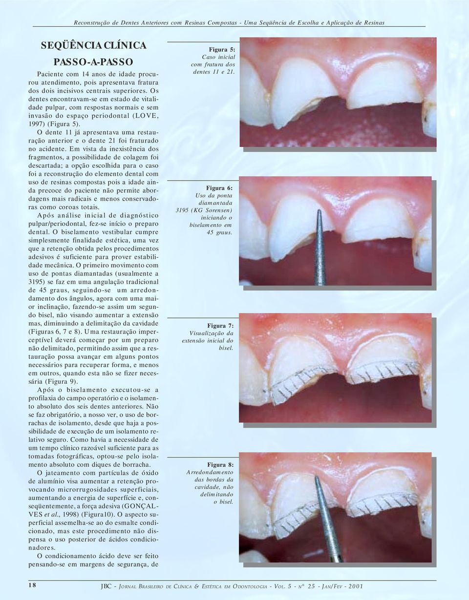 O dente 11 já apresentava uma restauração anterior e o dente 21 foi fraturado no acidente.