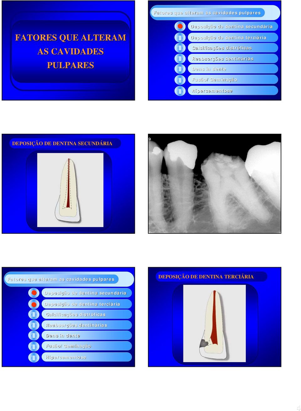 DENTINA SECUNDÁRIA Fatores que alteram as cavidades pulpares DEPOSIÇÃO DE DENTINA TERCIÁRIA RIA Deposição de dentina secundária