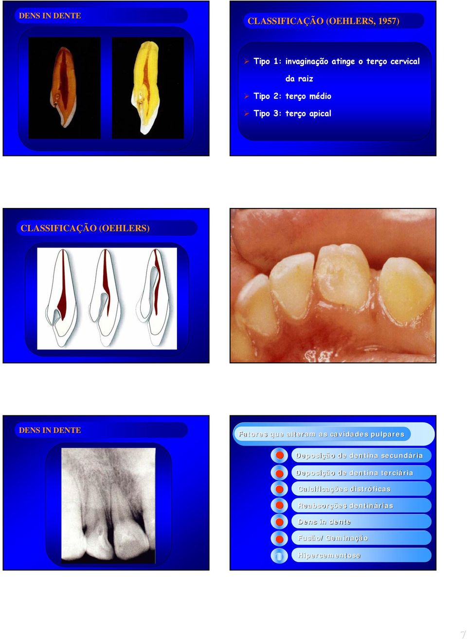 que alteram as cavidades pulpares Deposição de dentina secundária Deposição de dentina