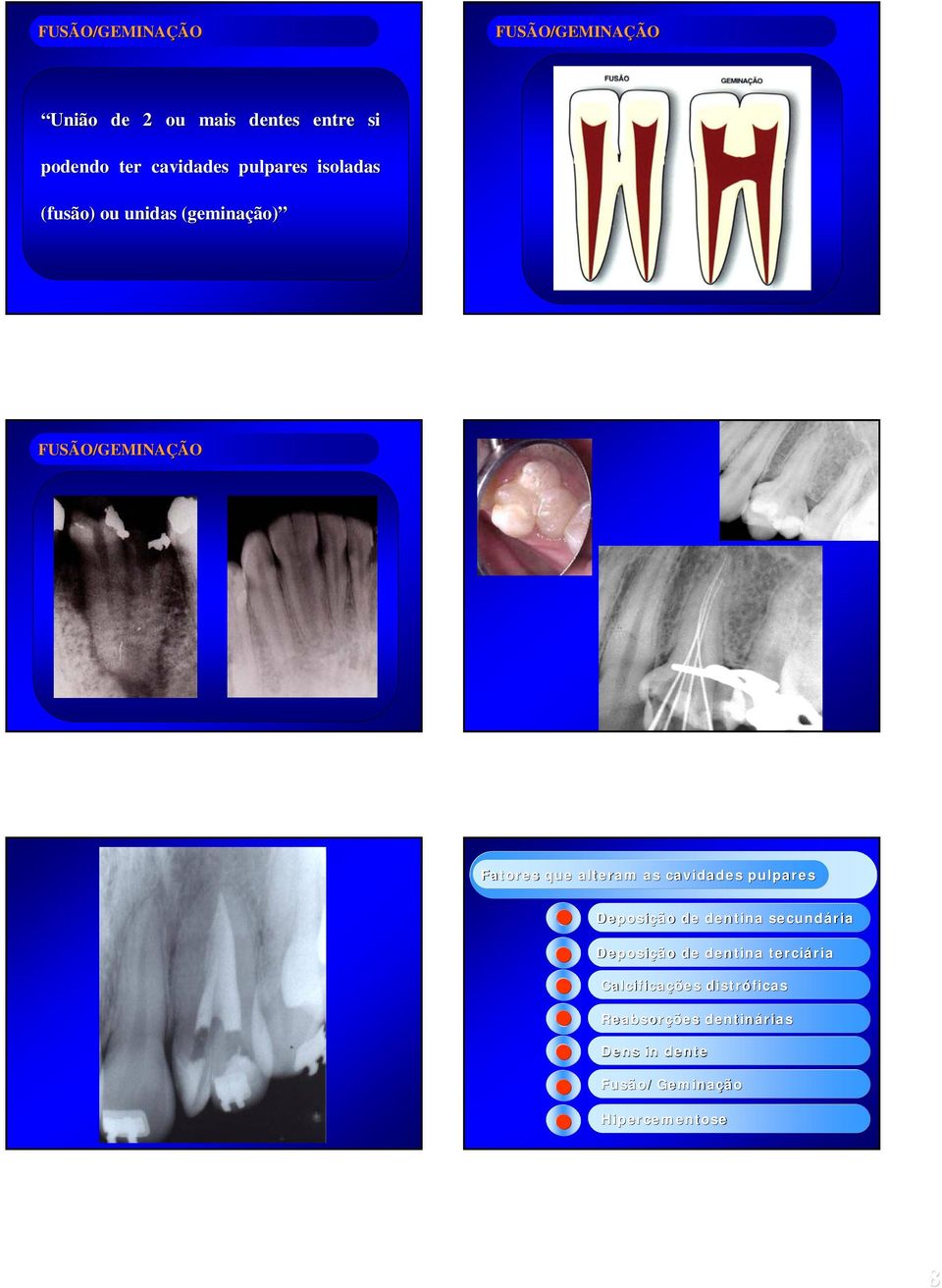 cavidades pulpares Deposição de dentina secundária Deposição de dentina terciária ria