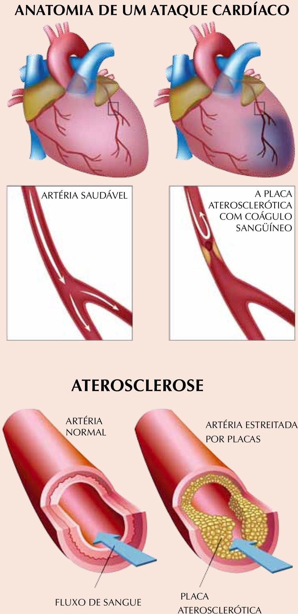 ATEROSCLEROSE ARTÉRIA NORMAL Artéria estreitada