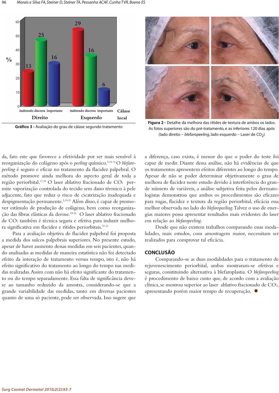 As fotos superiores são do pré-tratamento, e as inferiores 120 dias após (lado direito blefaropeeling, lado esquerdo Laser de CO 2 ) da, fato este que favorece a efetividade por ser mais sensível à