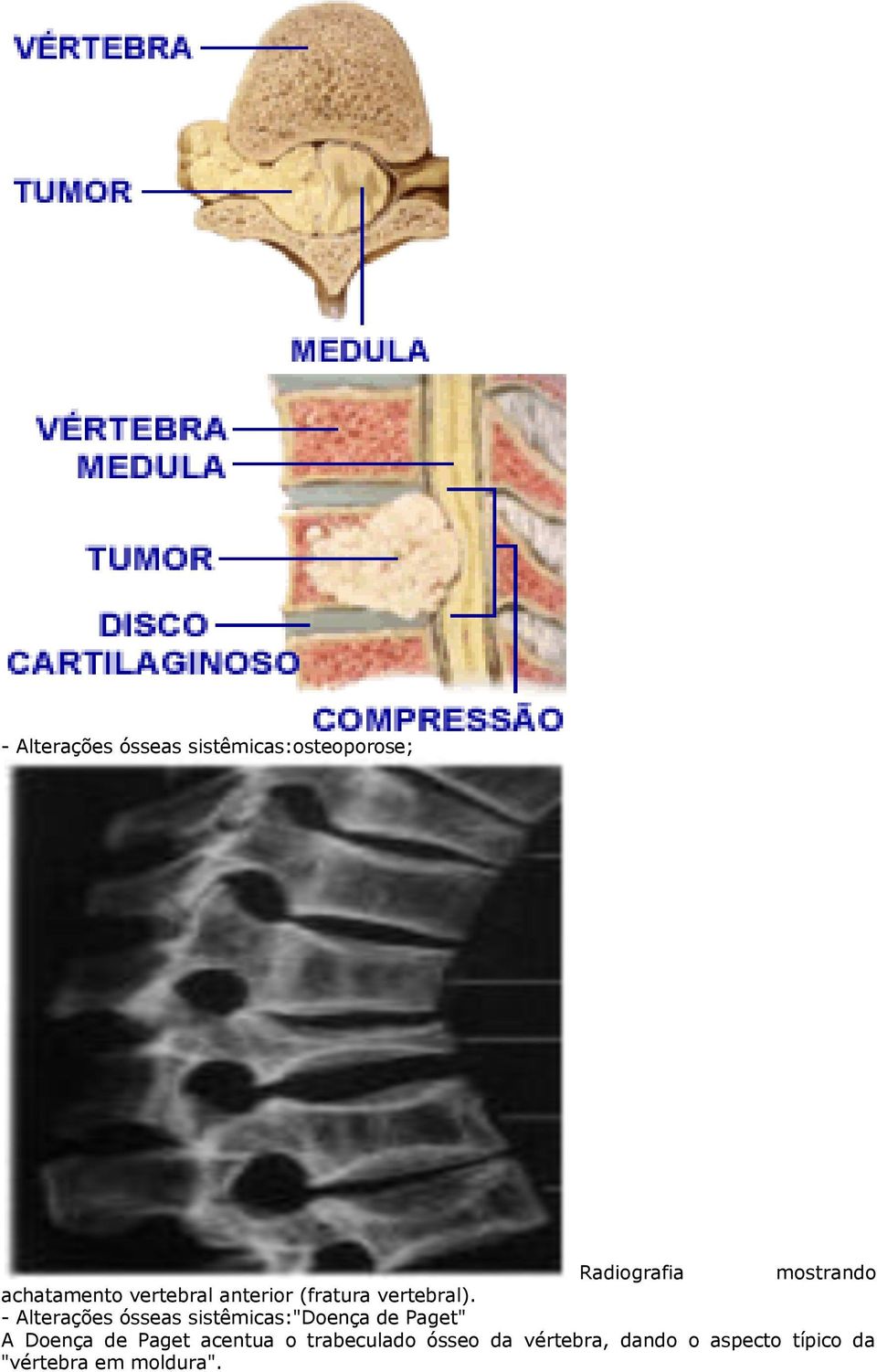 - Alterações ósseas sistêmicas:"doença de Paget" A Doença de Paget