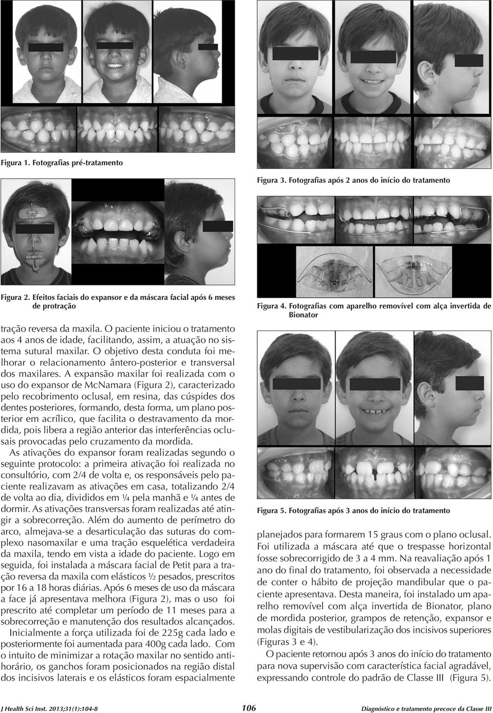 O paciente iniciou o tratamento aos 4 anos de idade, facilitando, assim, a atuação no sistema sutural maxilar.