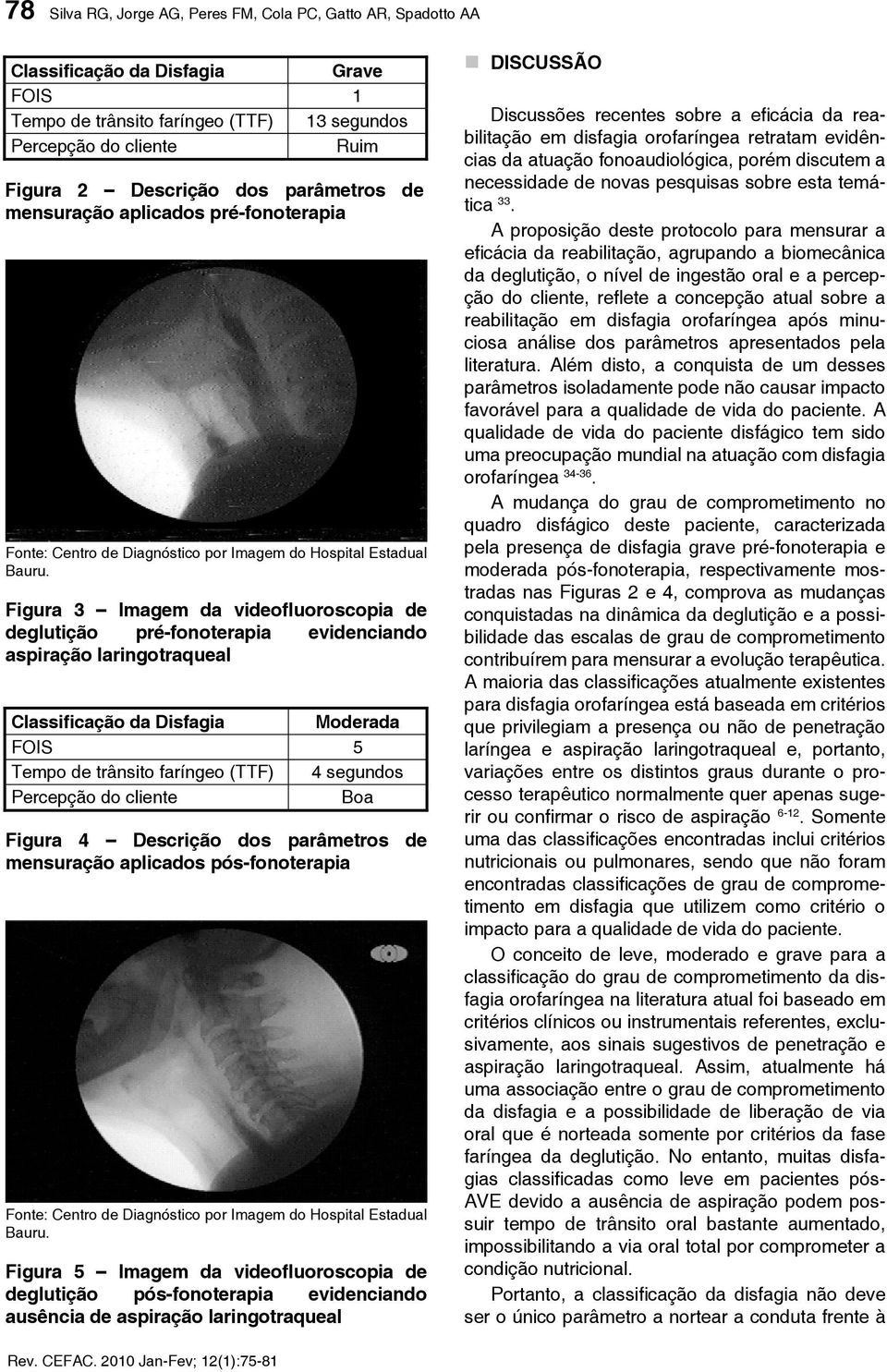 Figura 3 Imagem da videofluoroscopia de deglutição pré-fonoterapia evidenciando aspiração laringotraqueal Classificação da Disfagia Moderada FOIS 5 Tempo de trânsito faríngeo (TTF) 4 segundos