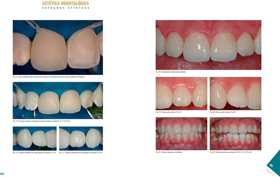 79 Close-up dos dentes 13 e 12. Fig. 80 Close-up dos dentes 22 e 23. Fig. 75 Incisivos centrais restaurados e vista do preparo nos dentes 13, 12, 22 e 23.