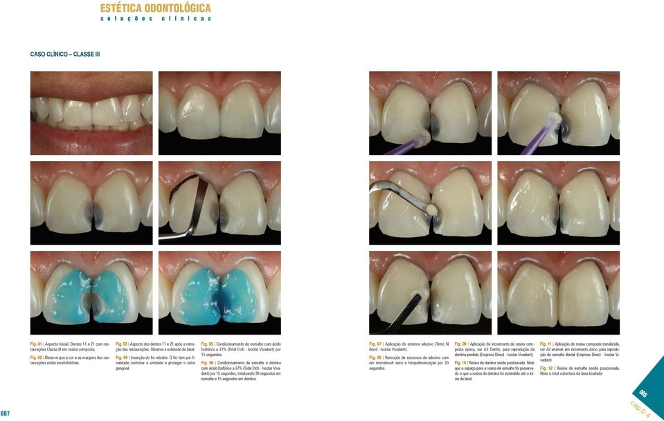 Fig. 06 Condicionamento de esmalte e dentina com ácido fosfórico a 37% (Total Etch - Ivoclar Vivadent) por 15 segundos, totalizando 30 segundos em esmalte e 15 segundos em dentina. Fig.