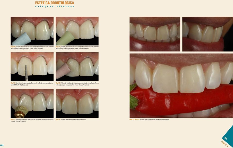 15 Macrotexturização de superfície sendo realizada com ponta diamantada 2135F e FF (KG Sorensen). Fig.