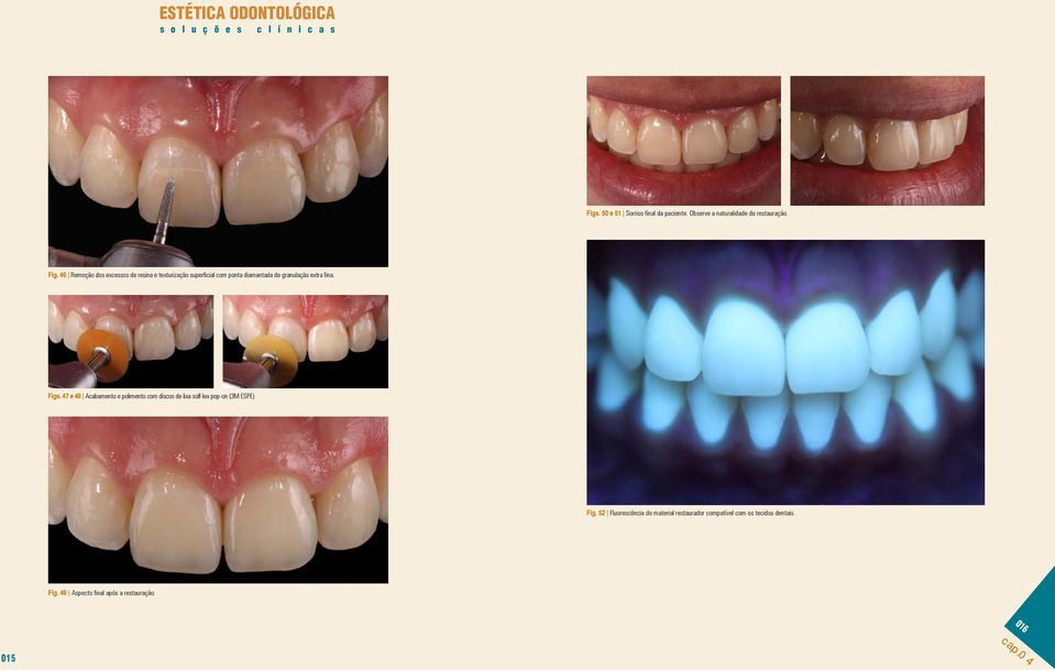 fina. Figs. 47 e 48 Acabamento e polimento com discos de lixa solf-lex pop-on (3M ESPE). Fig. 52 Fluorescência do material restaurador compatível com os tecidos dentais.