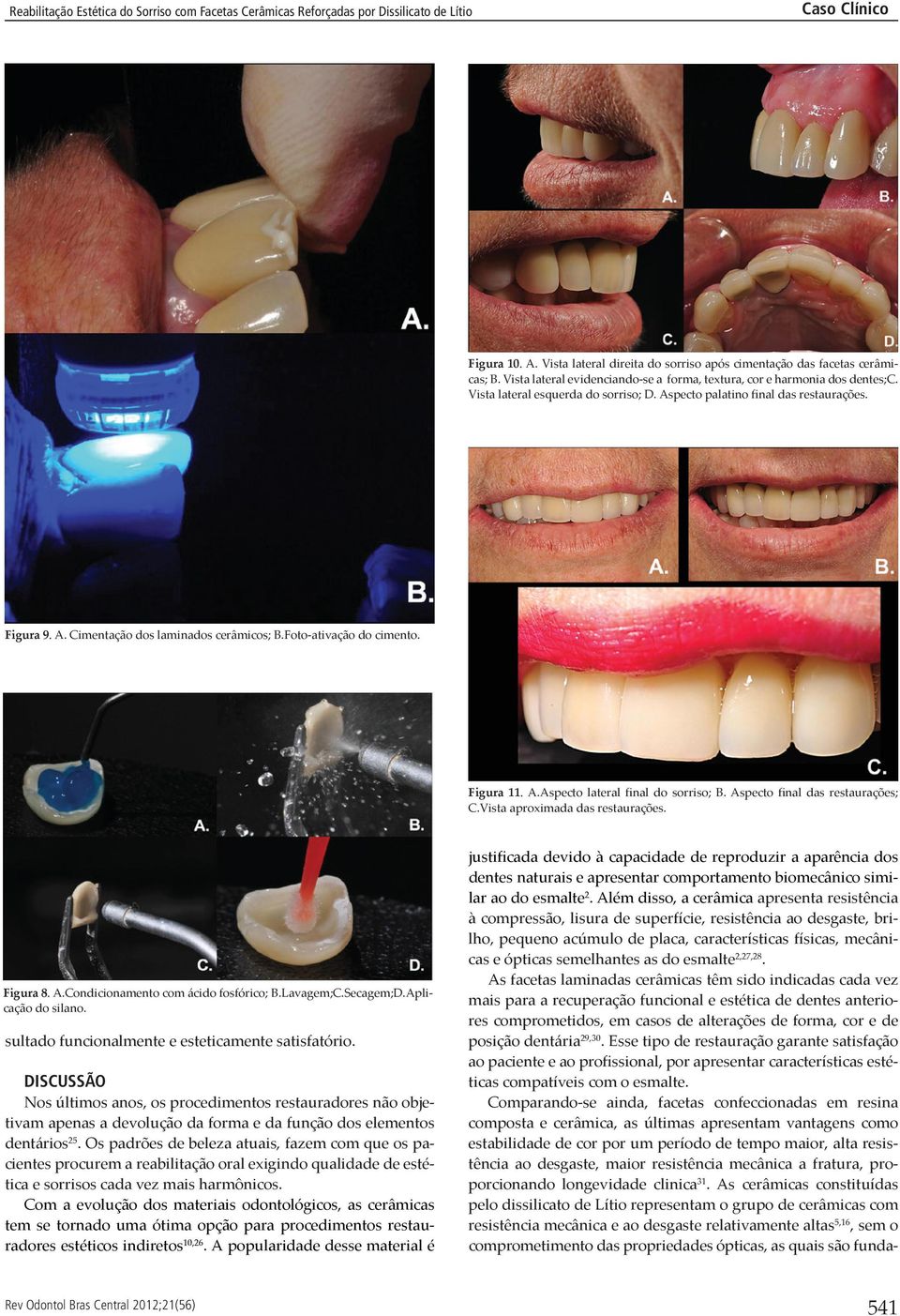 Aspecto final das restaurações; C.Vista aproximada das restaurações. Figura 8. A.Condicionamento com ácido fosfórico; B.Lavagem;C.Secagem;D.Aplicação do silano.