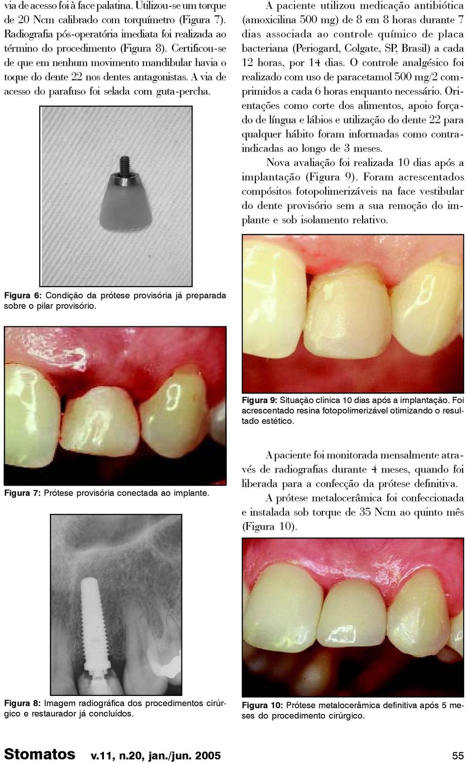 A paciente utilizou medicação antibiótica (amoxicilina 500 mg) de 8 em 8 horas durante 7 dias associada ao controle químico de placa bacteriana (Periogard, Colgate, SP, Brasil) a cada 12 horas, por