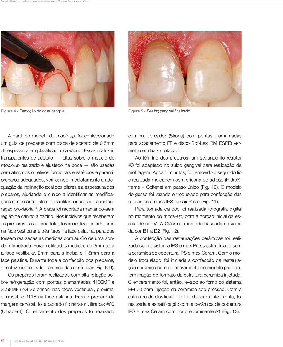 Essas matrizes transparentes de acetato feitas sobre o modelo do mock-up realizado e ajustado na boca são usadas para atingir os objetivos funcionais e estéticos e garantir preparos adequados,