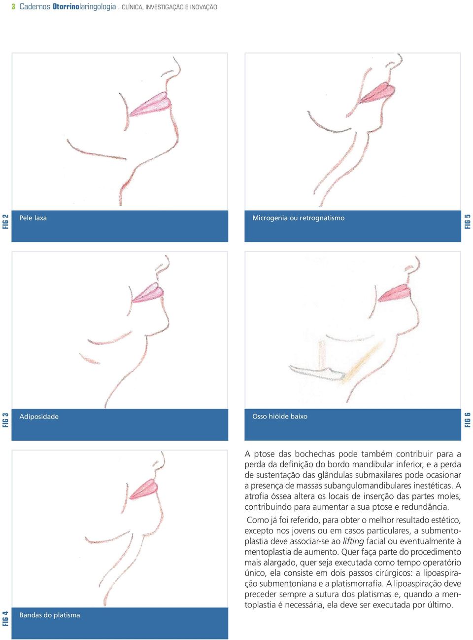 a perda da definição do bordo mandibular inferior, e a perda de sustentação das glândulas submaxilares pode ocasionar a presença de massas subangulomandibulares inestéticas.