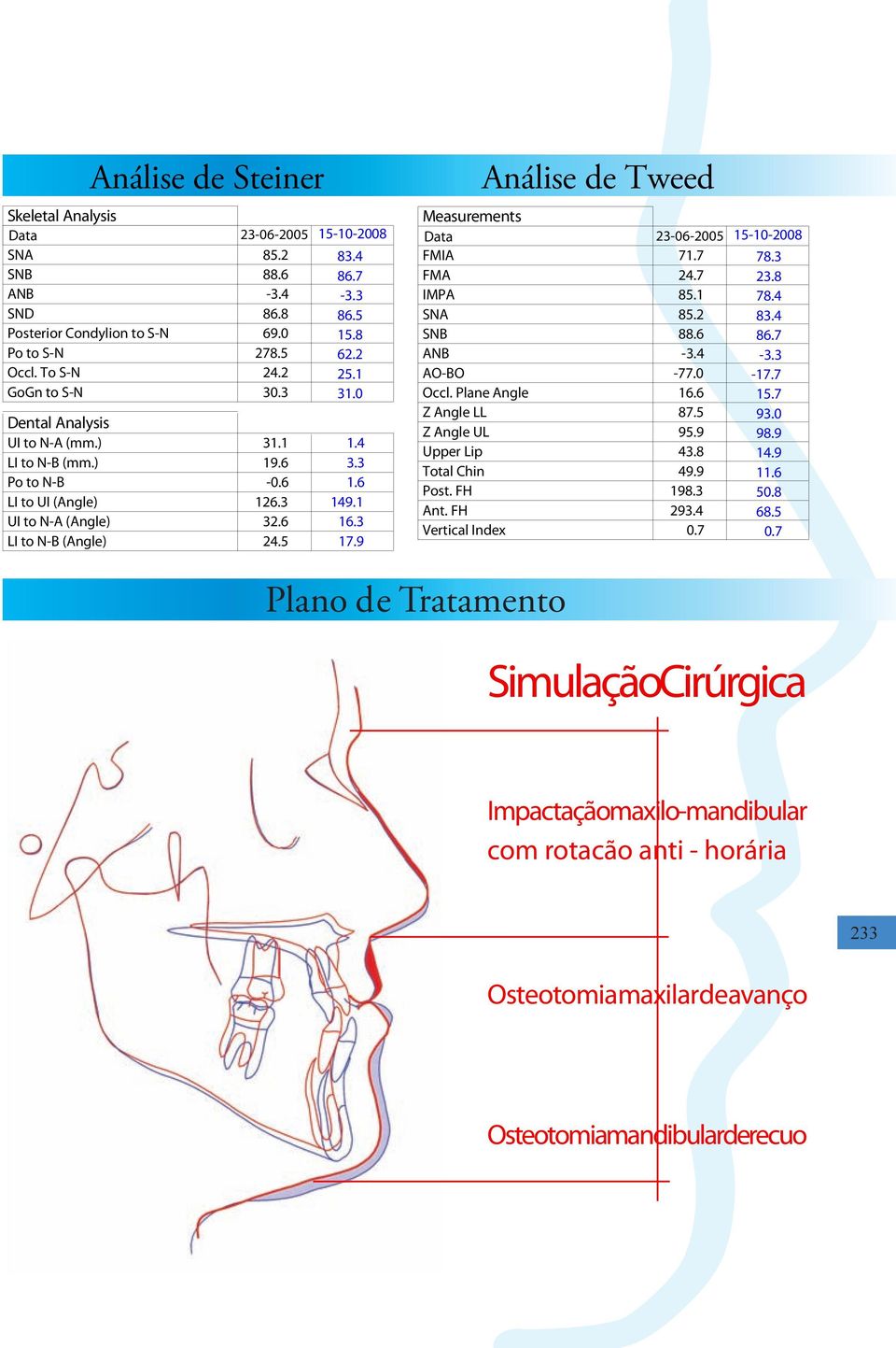 9 Análise de Tweed Measurements Data 23-06-2005 15-10-2008 FMIA 71.7 78.3 FMA 24.7 23.8 IMPA 85.1 78.4 SNA 85.2 83.4 SNB 88.6 86.7 ANB -3.4-3.3 AO-BO -77.0-17.7 Occl. Plane Angle 16.6 15.