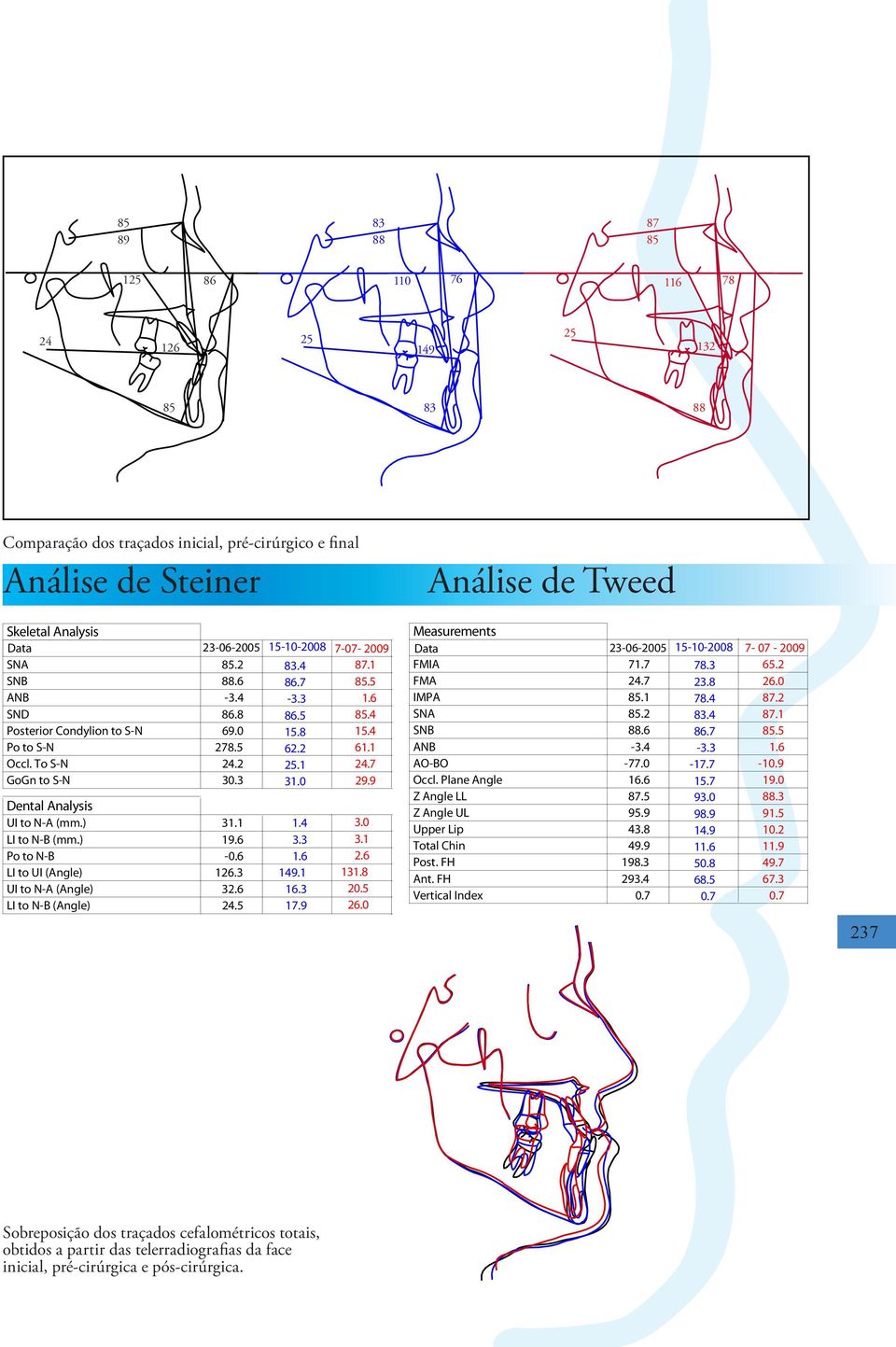 9 Dental Analysis UI to N-A (mm.) 31.1 1.4 3.0 LI to N-B (mm.) 19.6 3.3 3.1 Po to N-B -0.6 1.6 2.6 LI to UI (Angle) 126.3 149.1 131.8 UI to N-A (Angle) 32.6 16.3 20.5 LI to N-B (Angle) 24.5 17.9 26.