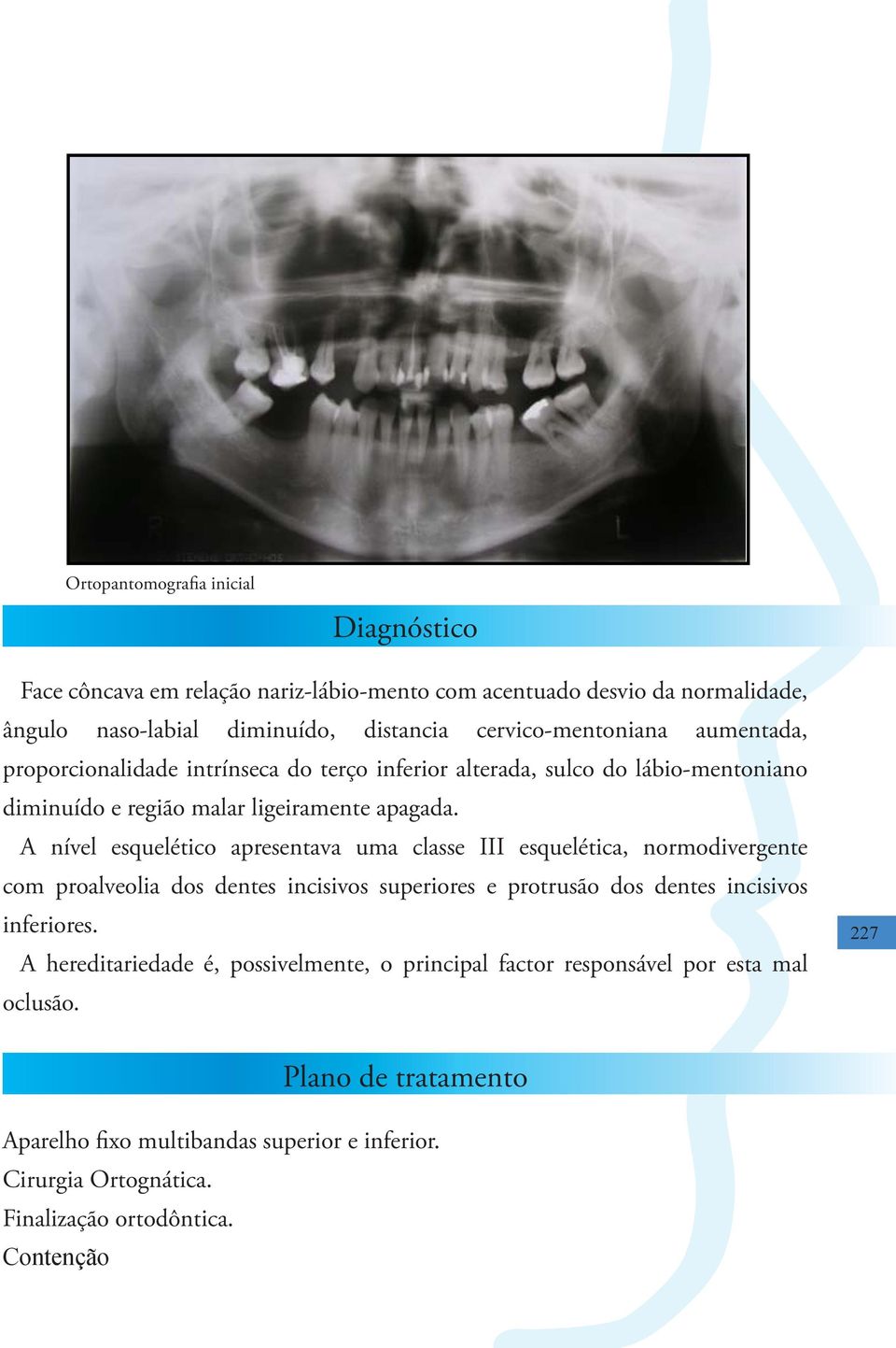 A nível esquelético apresentava uma classe III esquelética, normodivergente com proalveolia dos dentes incisivos superiores e protrusão dos dentes incisivos inferiores.