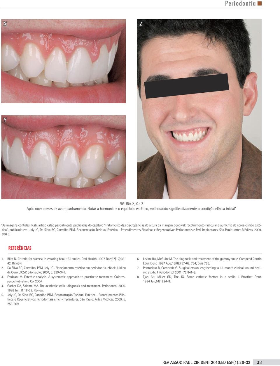 discrepâncias de altura da margem gengival: recobrimento radicular e aumento de coroa clínico estético, publicado em: Joly JC, Da Silva RC, Carvalho PFM.