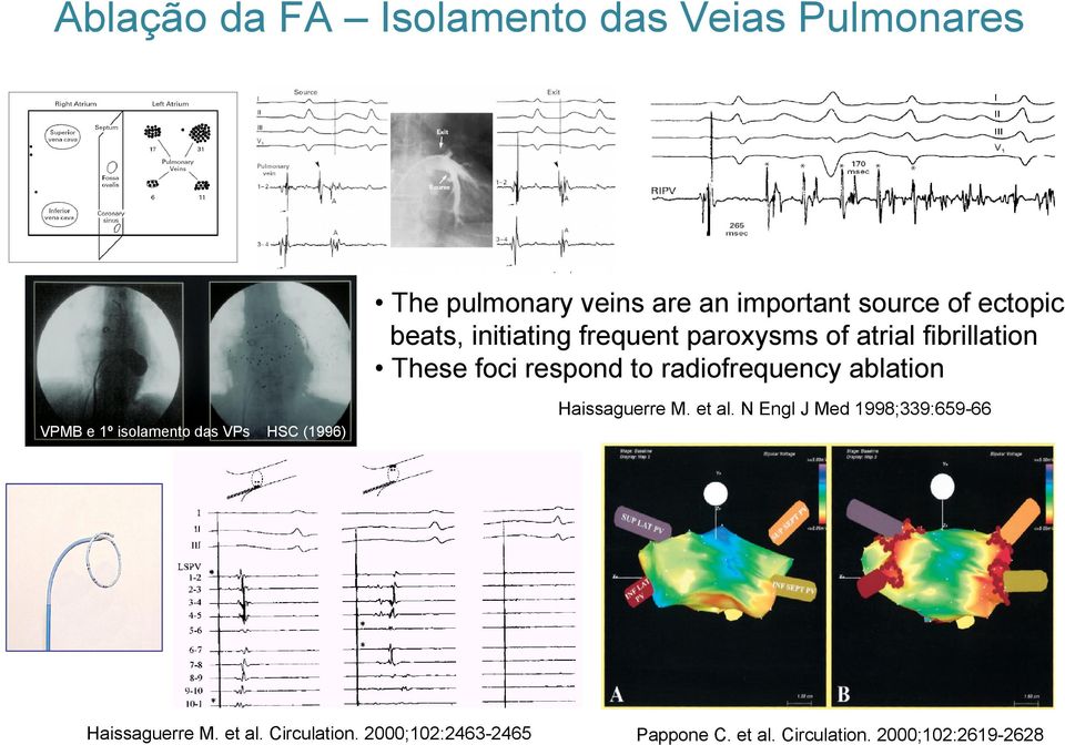 ablation VPMB e 1º isolamento das VPs HSC (1996) Haissaguerre M. et al.